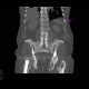 Fracture of pelvis, old: CT - Computed tomography